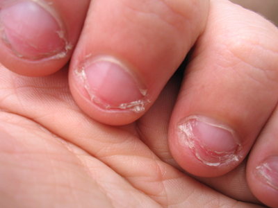 fingernaegel-kauen.JPG